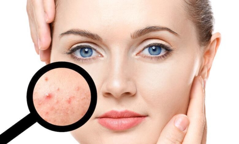 Simple steps to prevent acne from returning